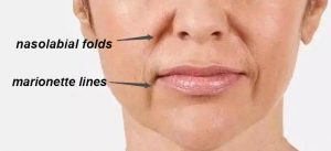 Marionette Lines: Causes, Prevention and Treatments