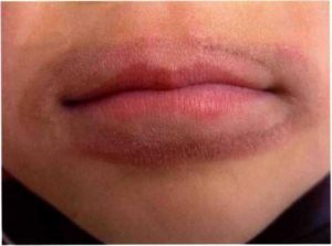 Lip Lickers Dermatitis: causes, treatment and prevention