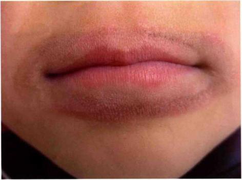 lip lickers dermatitis