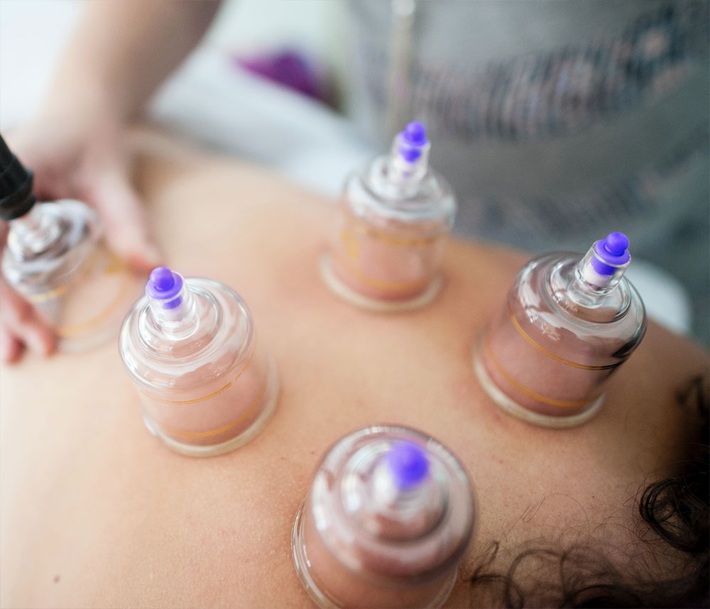 cupping therapy