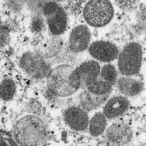 10 FAQs About Monkeypox, Symptoms & Prevention