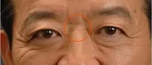 Bunny Lines: Cause, Tips for Bunny Lines Botulinus Injections