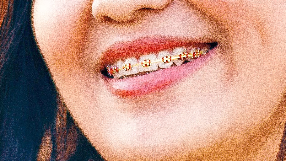 gold braces