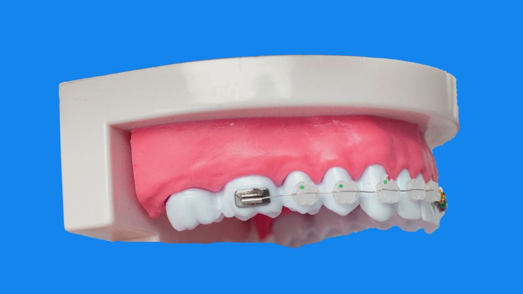 ceramic braces