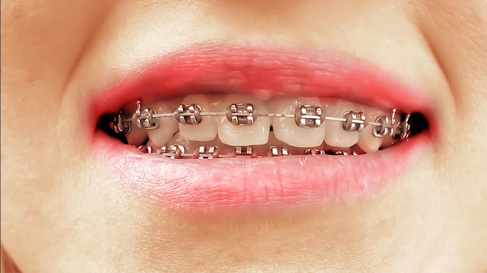 Metal Braces