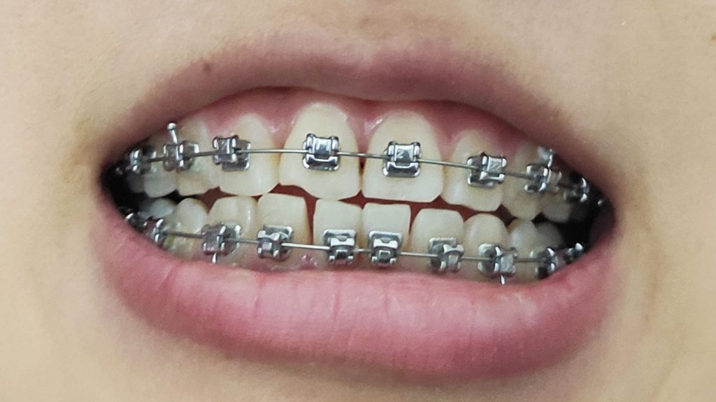 Self-ligating Braces