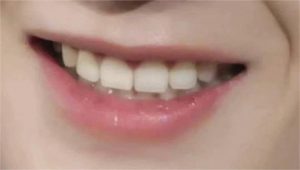 5 Causes of Yellow Teeth, Tips for Whitening Teeth